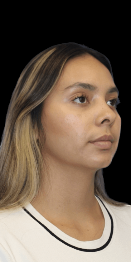 Primary Rhinoplasty Before & After Patient #1321