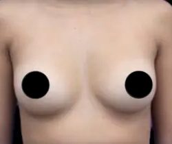 Breast Augmentation Before & After Patient #1329