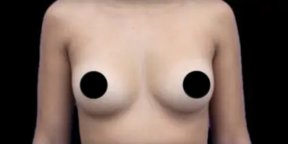 Breast Augmentation Before & After Patient #1329
