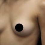 Breast Augmentation Before & After Patient #1328