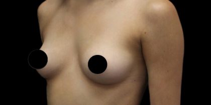 Breast Augmentation Before & After Patient #1328