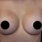 Breast Augmentation Before & After Patient #1328