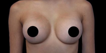 Breast Augmentation Before & After Patient #1328