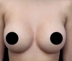 Breast Augmentation Before & After Patient #1329