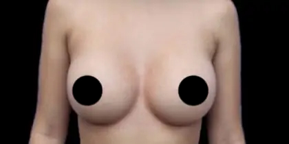 Breast Augmentation Before & After Patient #1329