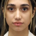 Primary Rhinoplasty Before & After Patient #1322