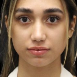 Primary Rhinoplasty Before & After Patient #1322