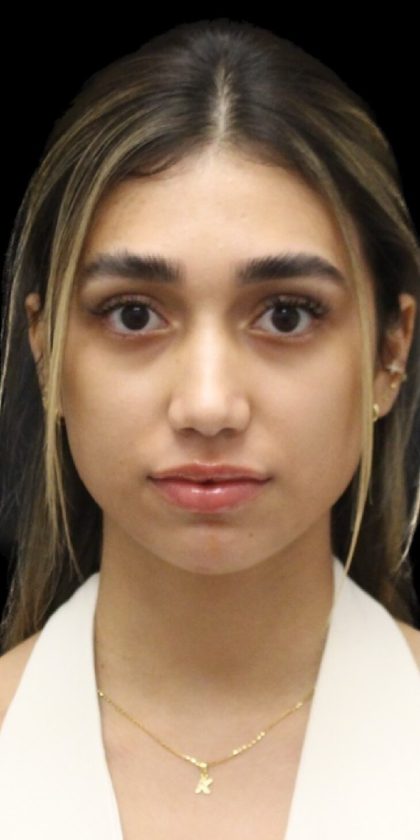 Primary Rhinoplasty Before & After Patient #1322