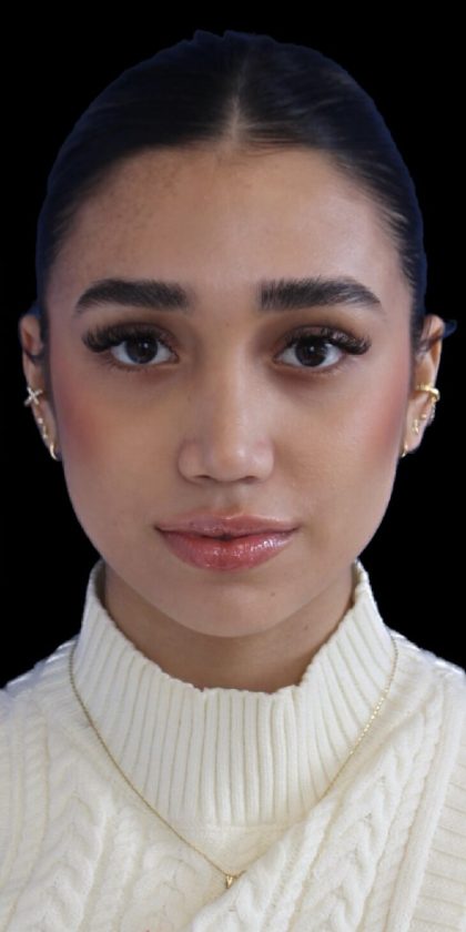 Primary Rhinoplasty Before & After Patient #1322