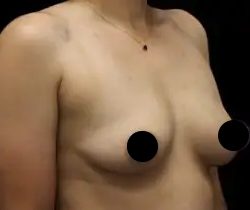 Breast Lift Before & After Patient #1337