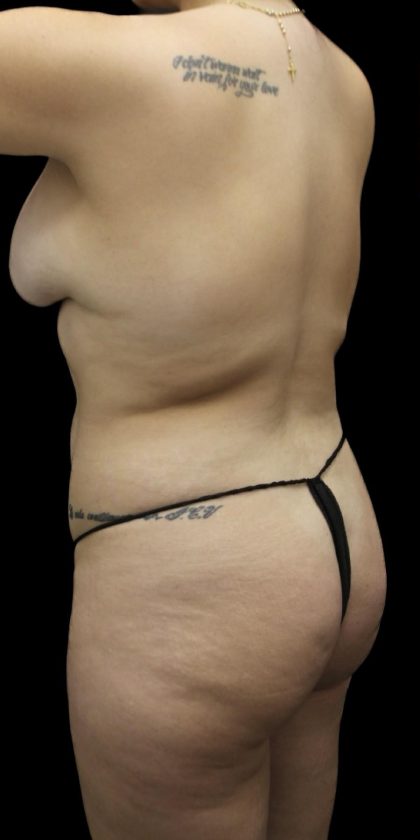 Brazilian Butt Lift Before & After Patient #1384