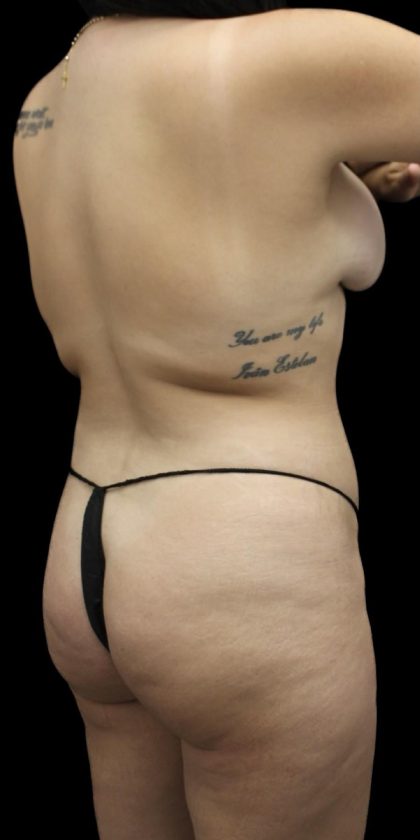Brazilian Butt Lift Before & After Patient #1384