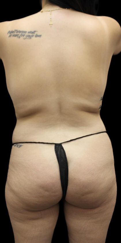 Brazilian Butt Lift Before & After Patient #1384