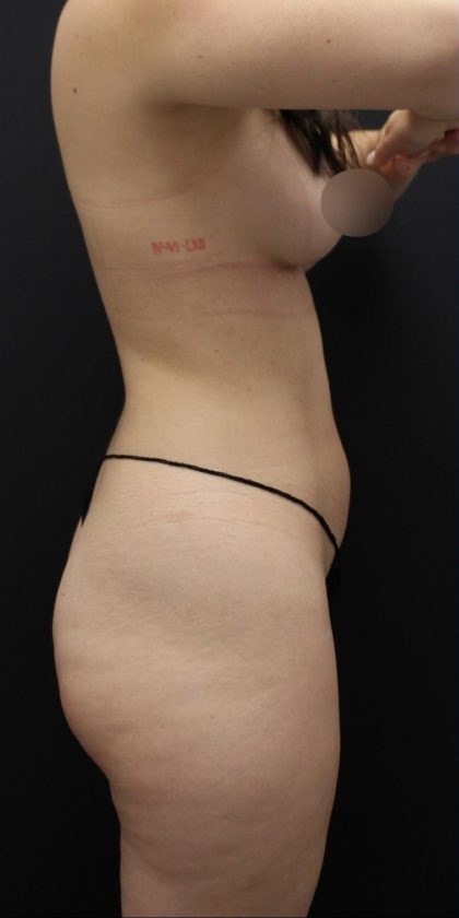 Brazilian Butt Lift Before & After Patient #1386