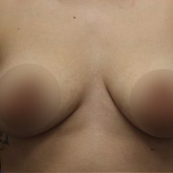 Breast Lift Before & After Patient #1380