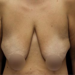 Breast Reduction Before & After Patient #1381