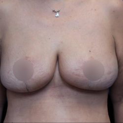 Breast Reduction Before & After Patient #1381