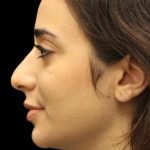 Primary Rhinoplasty Before & After Patient #1389