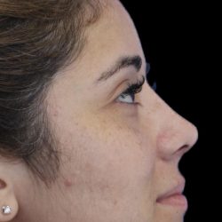 Primary Rhinoplasty Before & After Patient #1390