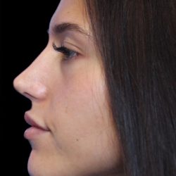 Primary Rhinoplasty Before & After Patient #1392