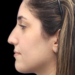 Primary Rhinoplasty Before & After Patient #1395