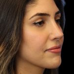 Primary Rhinoplasty Before & After Patient #1395