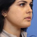 Neck Lift Before & After Patient #1502