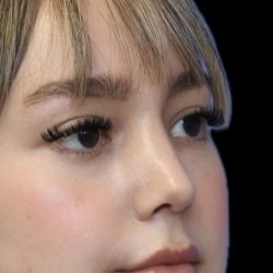 Primary Rhinoplasty Before & After Patient #1524