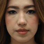 Primary Rhinoplasty Before & After Patient #1623