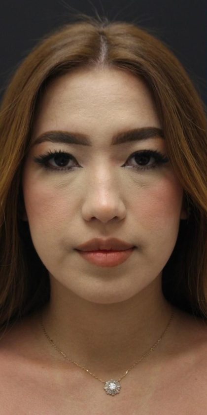 Primary Rhinoplasty Before & After Patient #1623