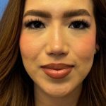 Primary Rhinoplasty Before & After Patient #1623
