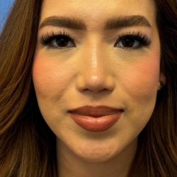 Primary Rhinoplasty Before & After Patient #1623