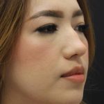 Primary Rhinoplasty Before & After Patient #1623