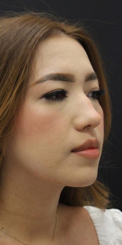 Primary Rhinoplasty Before & After Patient #1623