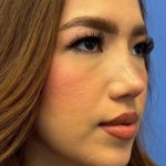 Primary Rhinoplasty Before & After Patient #1623