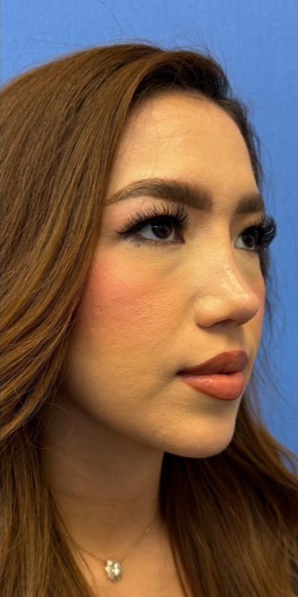 Primary Rhinoplasty Before & After Patient #1623