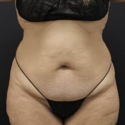 Tummy Tuck Before & After Patient #1614