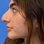 Primary Rhinoplasty Before & After Patient #1617