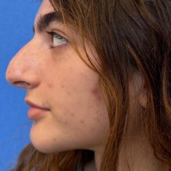 Primary Rhinoplasty Before & After Patient #1617