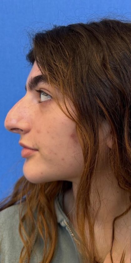 Primary Rhinoplasty Before & After Patient #1617
