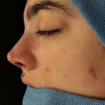Primary Rhinoplasty Before & After Patient #1617