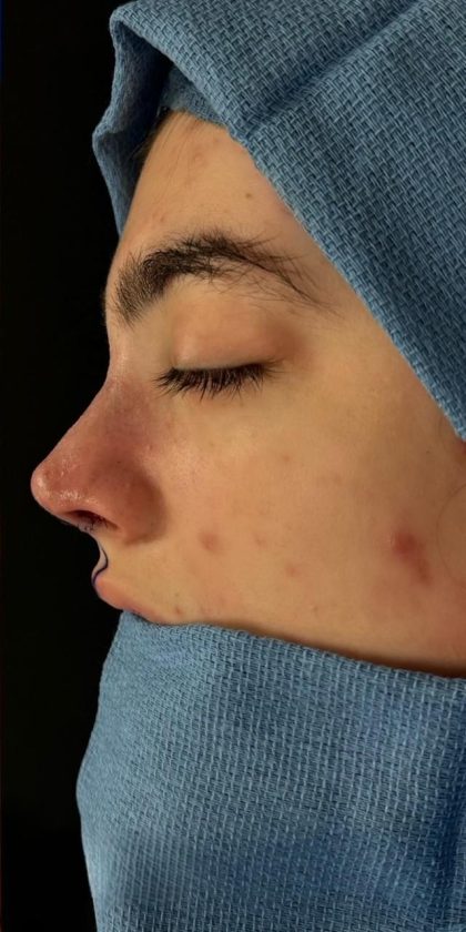 Primary Rhinoplasty Before & After Patient #1617