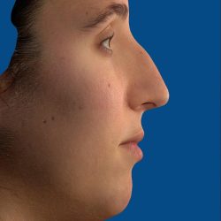 Vectra Before & After Patient #2271