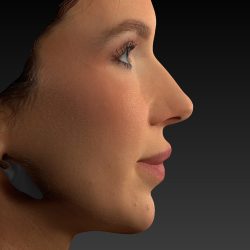 Vectra Before & After Patient #2273