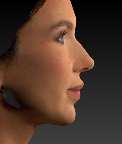 Vectra Before & After Patient #2273