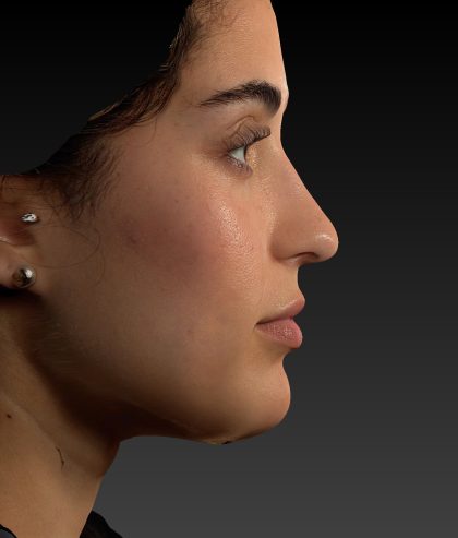Vectra Before & After Patient #2272
