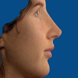 Vectra Before & After Patient #2274