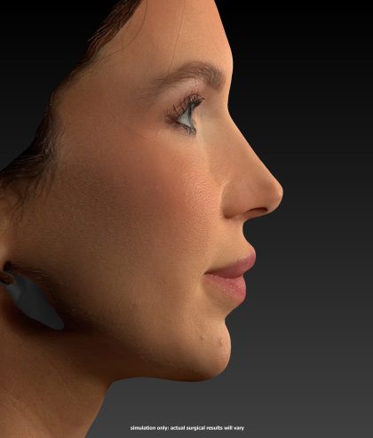 Vectra Before & After Patient #2273