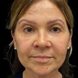 Facelift Before & After Patient #3407