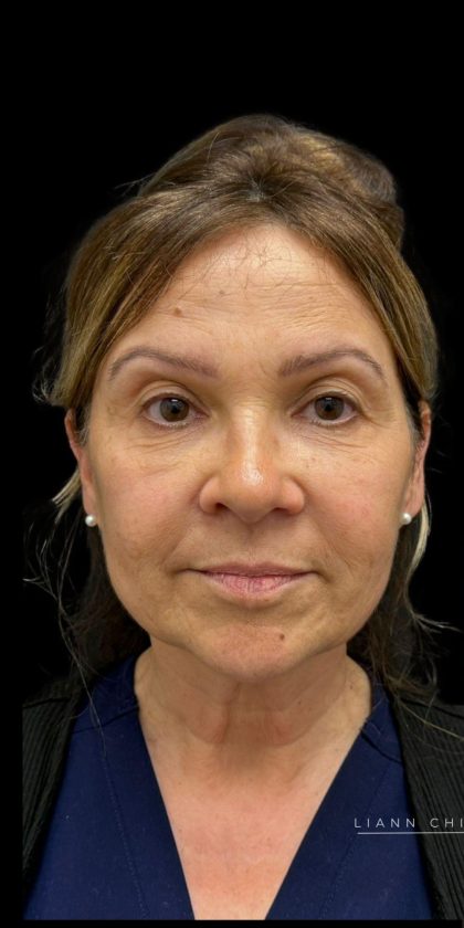 Facelift Before & After Patient #3407
